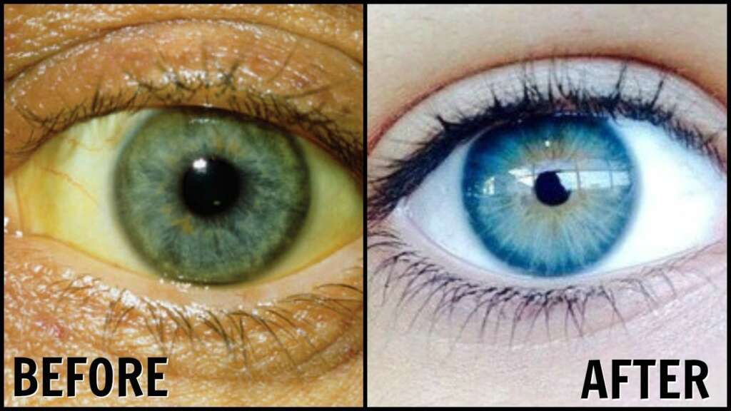 Gain White Eyes: Natural Remedies for Bright, Healthy Eyes Now 2024