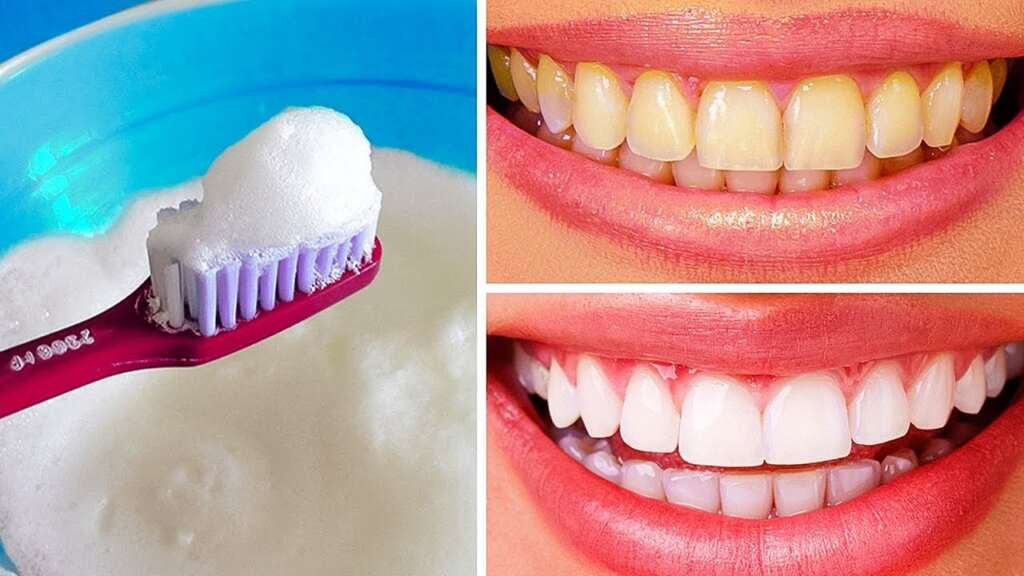 Whiten Teeth Naturally in 30 Days: A Strong Brighter Smile Awaits!